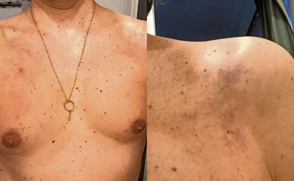 La agresión le habría provocado dolor que se agravó, protusiones en el cuello y tinnitus (zumbido en los oídos) Foto: Martin Bello