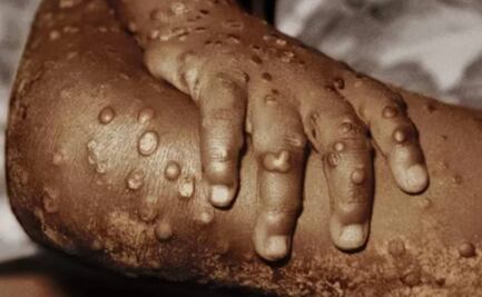 Argentina reporta el primer caso de viruela del mono en América Latina