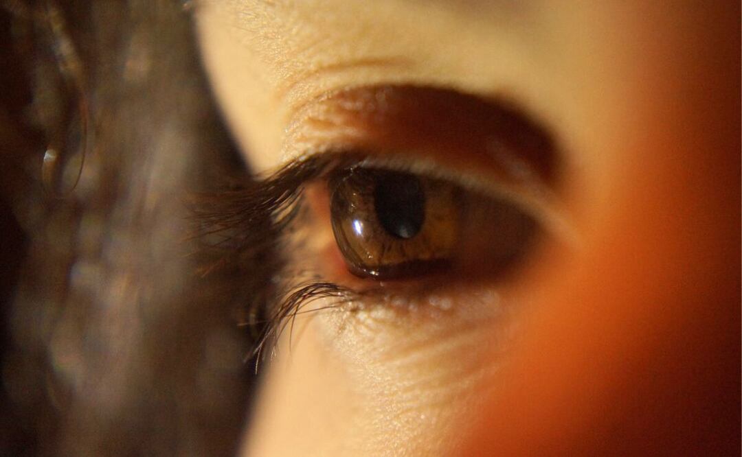 Glaucoma. Fuente: Pixabay