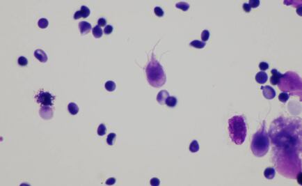 Parásito afecta desarrollo físico e intelectual en niños