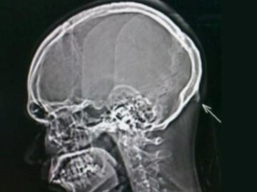 Uso de celulares provocaría crecimiento de “cuerno” en las personas