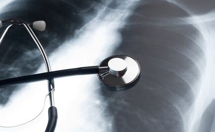 Esta técnica permitirá rehabilitar pulmones dañados