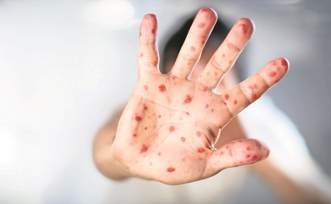 En Estados Unidos se han registrado 800 casos de sarampión durante el año 2025. Foto: Especial