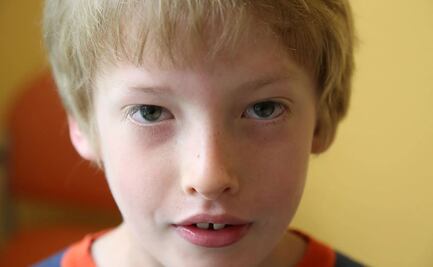 ¿Qué es el Síndrome 22q11?; estas son las características de quienes lo padecen