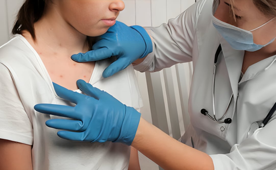 Sarampión. Foto: Pixabay