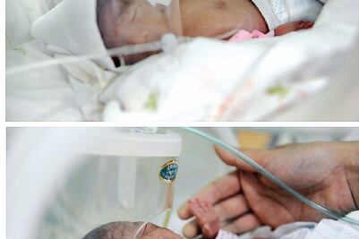 Ssa diagnostica y trata retinopatía del prematuro