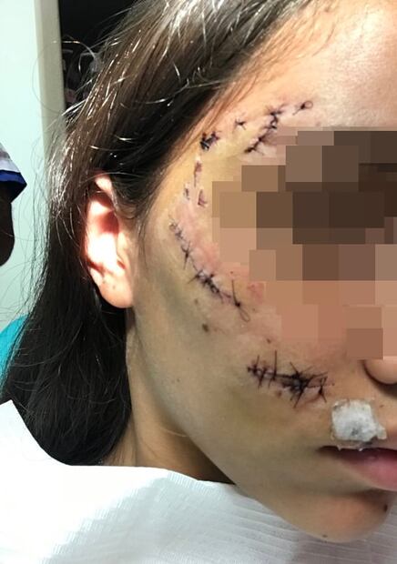 El peor final. Se sacaba fotos con un perro, le mordió la cara y le hicieron 40 puntos