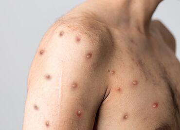 Salud reporta 2 mil 468 casos de viruela símica en México