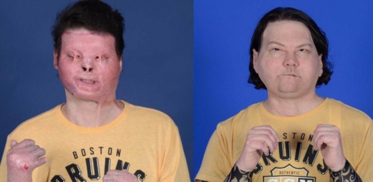 Realizan primer trasplante exitoso de manos y cara simultáneo en Estados Unidos