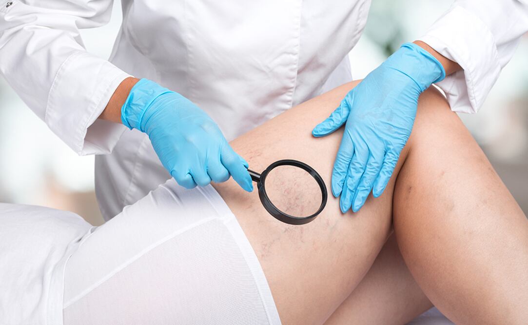 Prevención y cuidado de la insuficiencia venosa para mejorar la calidad de vida