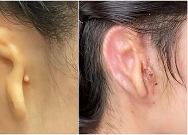 Con tejido vivo de cartílago, científicos reconstruyen una oreja