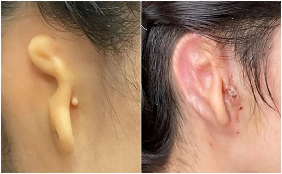 Trasplante de oreja humana, parte de ensayo clínico fase I/II. Foto: Concedida por Arturo Bonilla, vía Europa Press