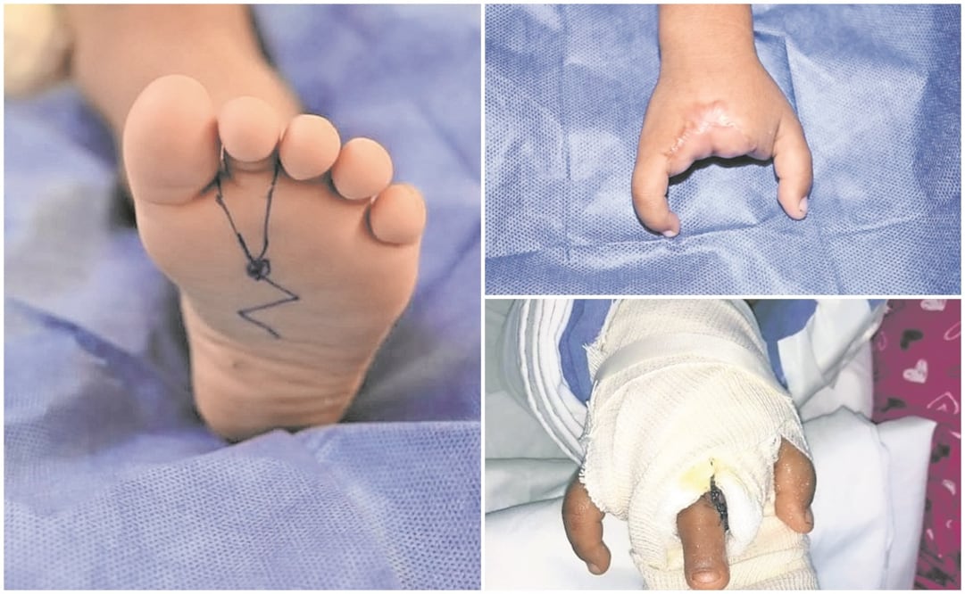 La niña José María perdió tres dedos al meter la mano derecha en un molino, por lo que médicos tabasqueños le colocaron un dedo del pie en medio de la mano, a modo de una pinza, para que pueda agarrar las cosas. Fotos: Cortesía