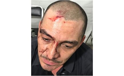 José Manuel Figueroa se cae del caballo y muestra sus heridas