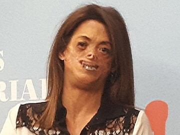 Así es vivir con la rara enfermedad porfiria de Günther