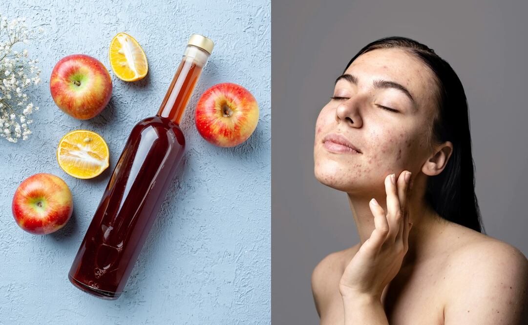 El vinagre de manzana cuenta con propiedades antibacterianas para la piel. Foto: Freepik