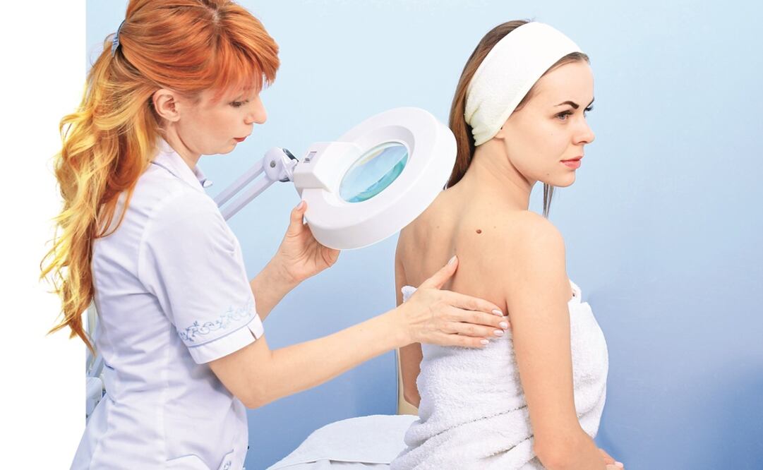 El inicio del melanoma suele ser la aparición de un lunar en la piel. Foto: Mykola Kovalchinskyy
