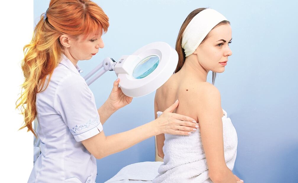 El inicio del melanoma suele ser la aparición de un lunar en la piel. Foto: Mykola Kovalchinskyy