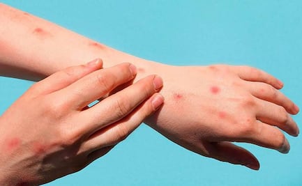 Sube a 91 el número de casos de viruela del mono en México, confirma Salud