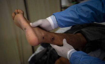 OMS ve signos "esperanzadores" de retroceso de viruela del mono en Europa