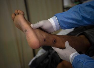 OMS ve signos "esperanzadores" de retroceso de viruela del mono en Europa