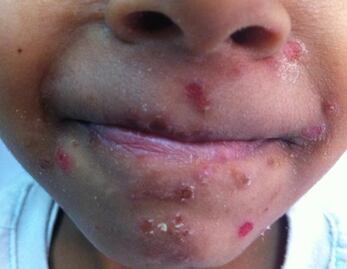 El virus del coxsackie ataca también a adultos