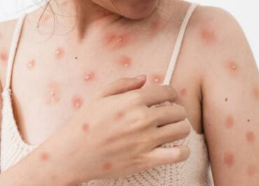 Mpox: China refuerza controles fronterizos ante propagación de la enfermedad