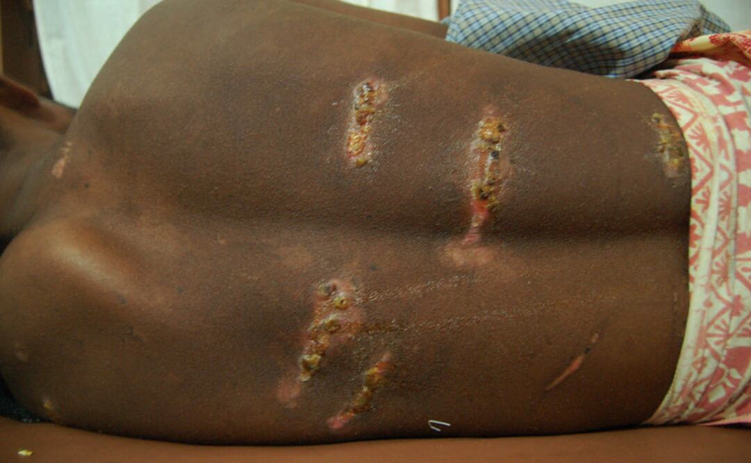 A Rohingya refugee shows the wound on his back which he says he received during a beating - Photo: Deny Sitohang/AP