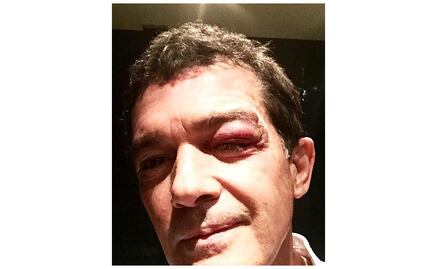 Antonio Banderas sufre accidente en filmación