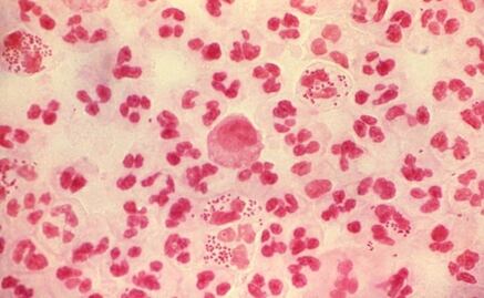 Investigan un brote de gonorrea multirresistente