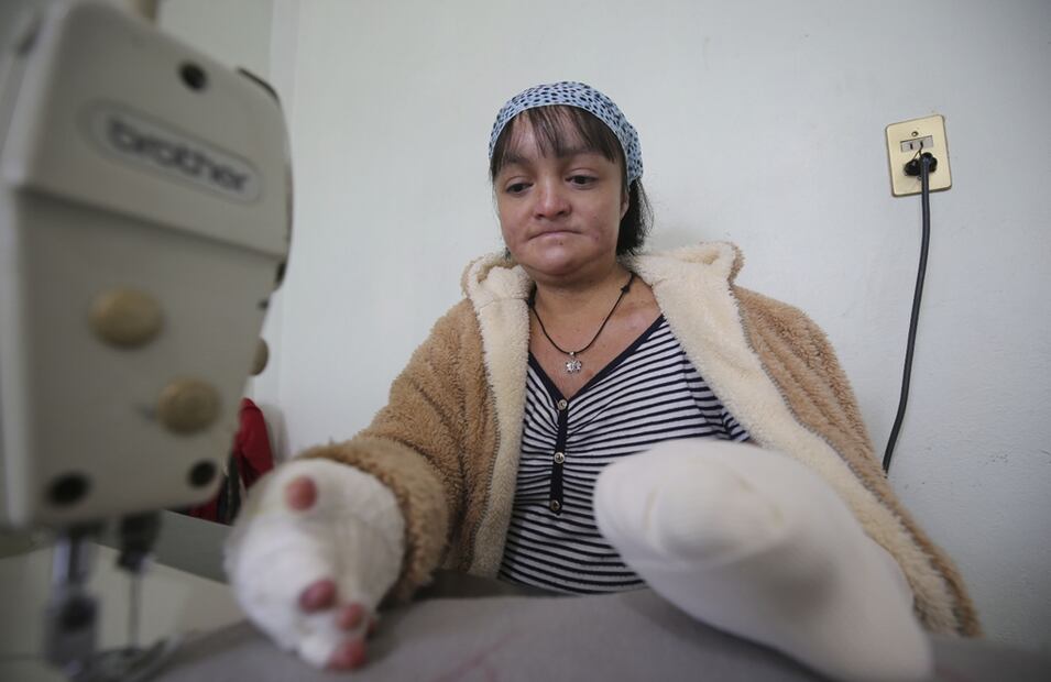 La piel de mariposa provoca ampollas dolorosas que pueden aparecer en cualquier parte del cuerpo. Foto: Archivo EL UNIVERSAL