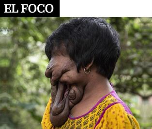 El Foco. Mujer india vive sin rostro