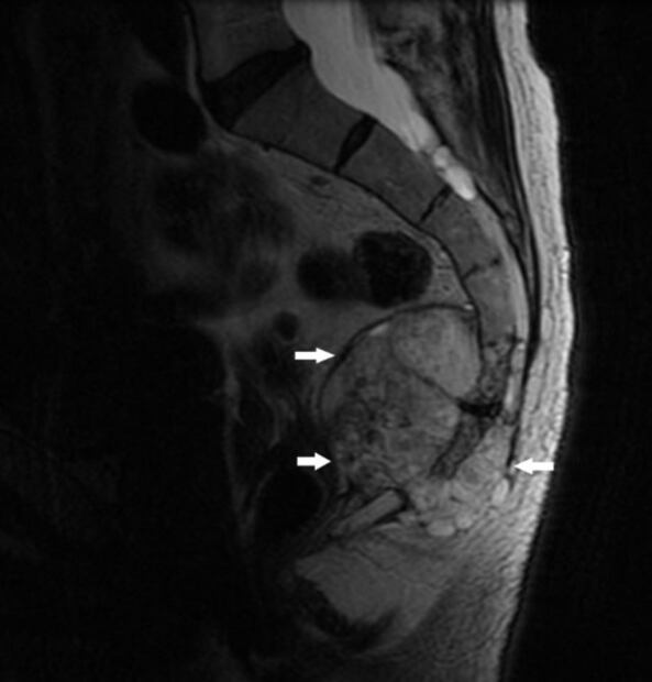 ¿Qué es el sarcoma de Ewing, enfermedad que padeció la influencer Elena Huelva?