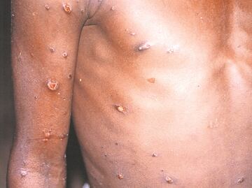¿Viruela del mono se transmite sexualmente? Hallan virus en semen de pacientes infectados