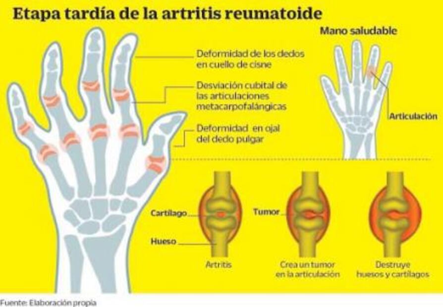 Volver a dibujar con artritis reumatoide