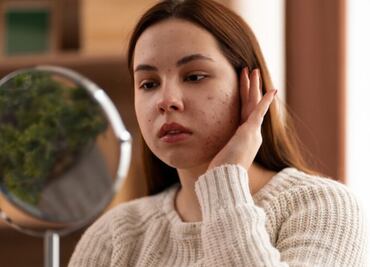 Conoce el motivo por el que aparece acné cuando las mujeres están menstruando