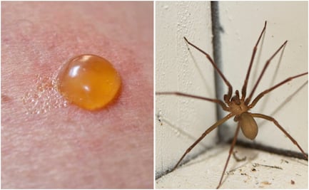Piquete de araña violinista: ¿cómo identificarla y qué hacer si te pica?