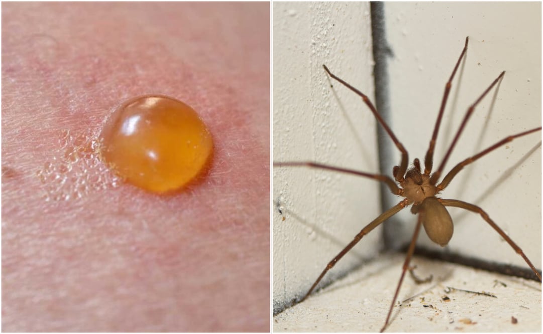 Piquete de araña violinista: ¿cómo identificarla y qué hacer si te pica? Foto: Canva / UNAM Global