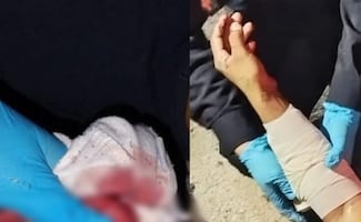 Riña en Yucatán deja un hombre herido con machete; agresión habría ocurrido por robo de un perro