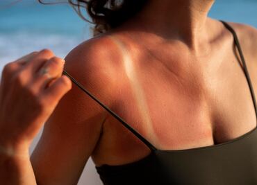 El secreto mejor guardado para aliviar las quemaduras del sol; un alimento sencillo pero potente