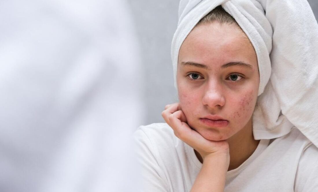 Las mujeres adultas con acné son más propensas a sufrir problemas de ansiedad. Fuente: Freepik.
