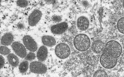 Transmisión de viruela del mono "puede detenerse en países no endémicos, se puede controlar": OMS