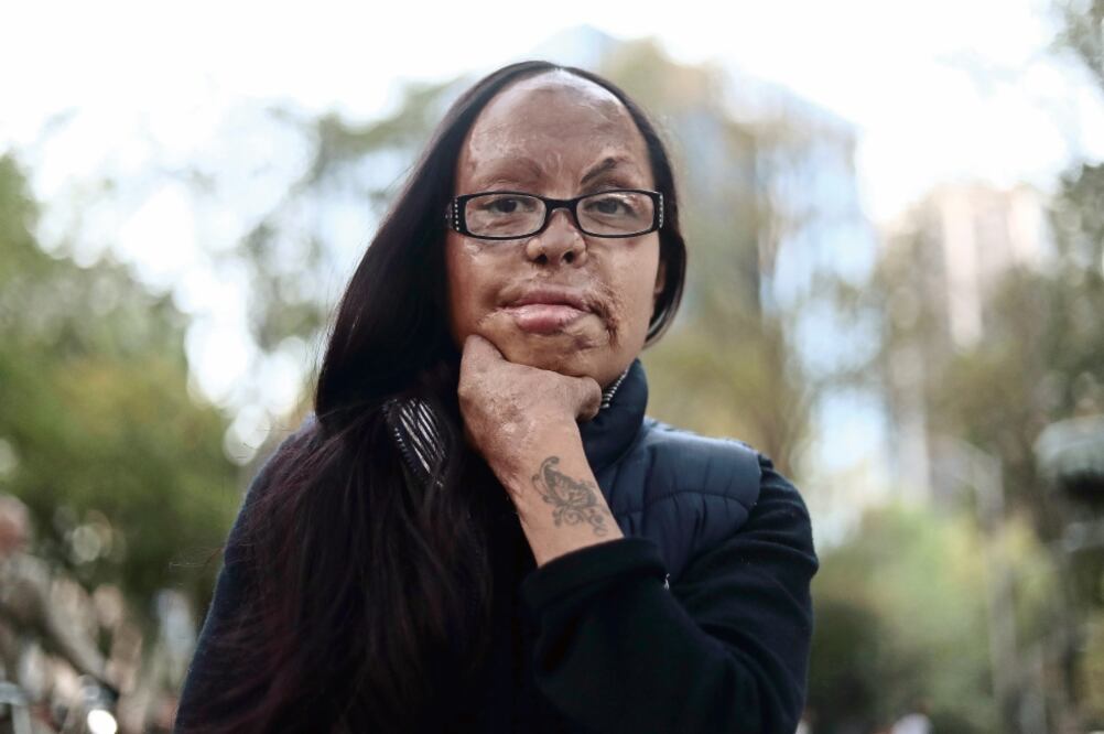 Cuando tenía un año, Carolina, junto con su familia, quedó atrapada entre las llamas del fuego tras una explosión en cadena originada en una planta de Pemex, en San Juan Ixhuatepec; no recibe una pensión pese a que sufrió quemaduras graves.