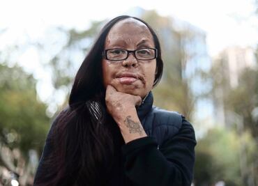 "Viví el dolor de las quemaduras"