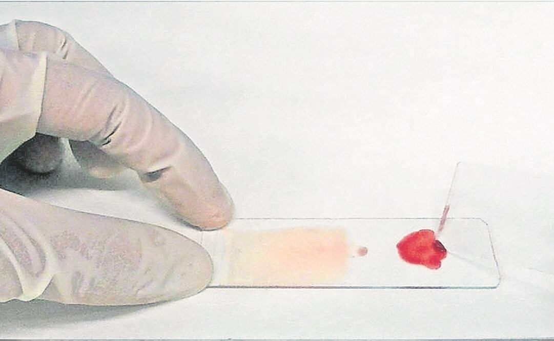 Hay cuatro clases de plasmodium que transmiten la malaria a los humanos: el vivax, el malariae, el ovale y el falciparum (éste último es el más letal y prevalente en África). FOTO: Archivo/ EL UNIVERSAL