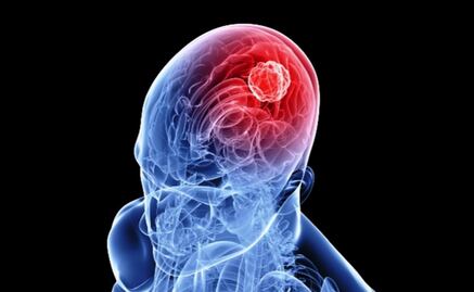 Infarto cerebral es tercera causa de muerte en el país