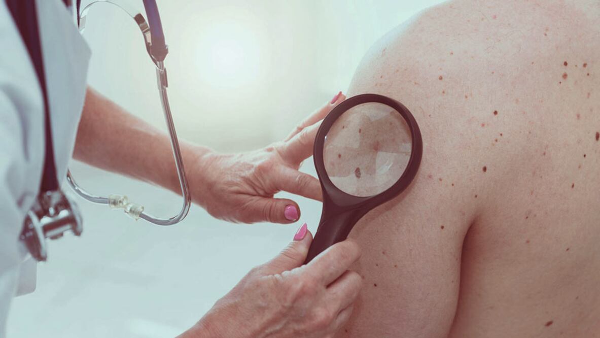 Aumenta cáncer de piel en población más joven
