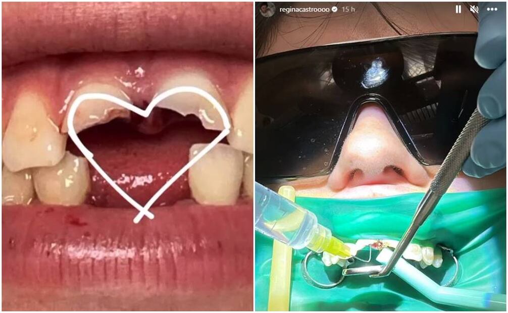 Regina Castro, de 18 años, mostró lo que ocurrió con sus dientes tras accidente.
