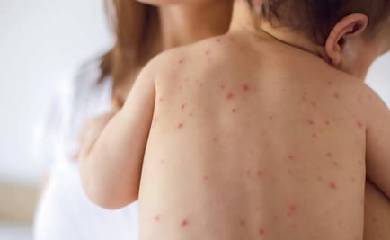 Secretaría de Salud confirma 12 casos de sarampión en 4 estados del país