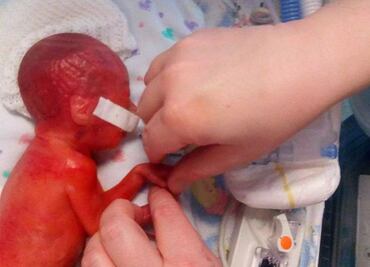 Mujer muestra cómo su bebé prematura nació con la piel roja y casi transparente